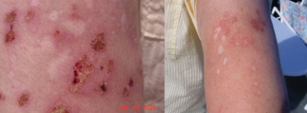 Morgellons lesions on arm